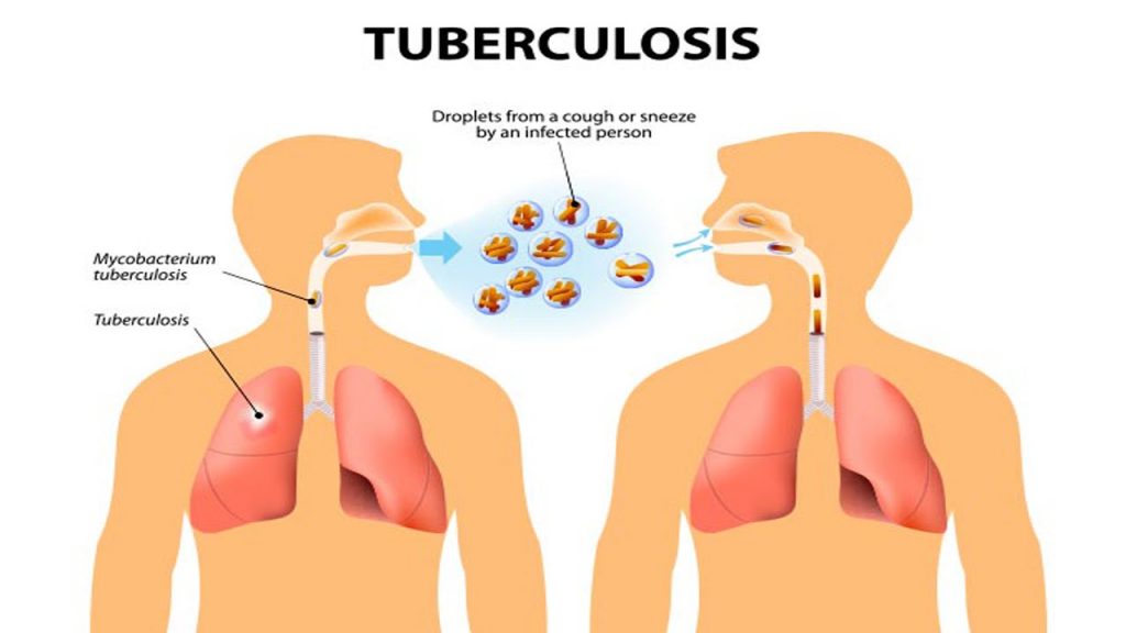 tuberculosis 1024x576