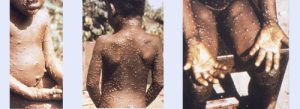 monkeypox homepage images 3 300x109
